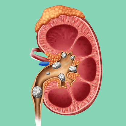 गुर्दे की पथरी के इलाज