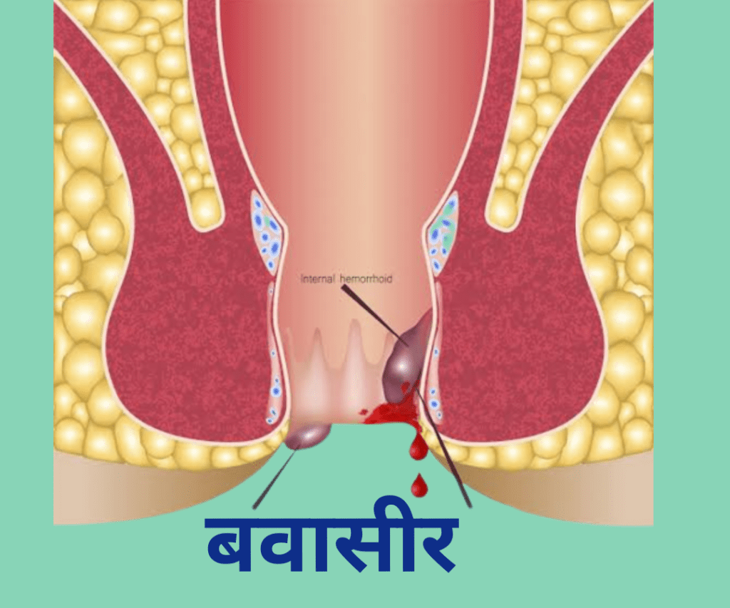 बवासीर के लिए टेबलेट